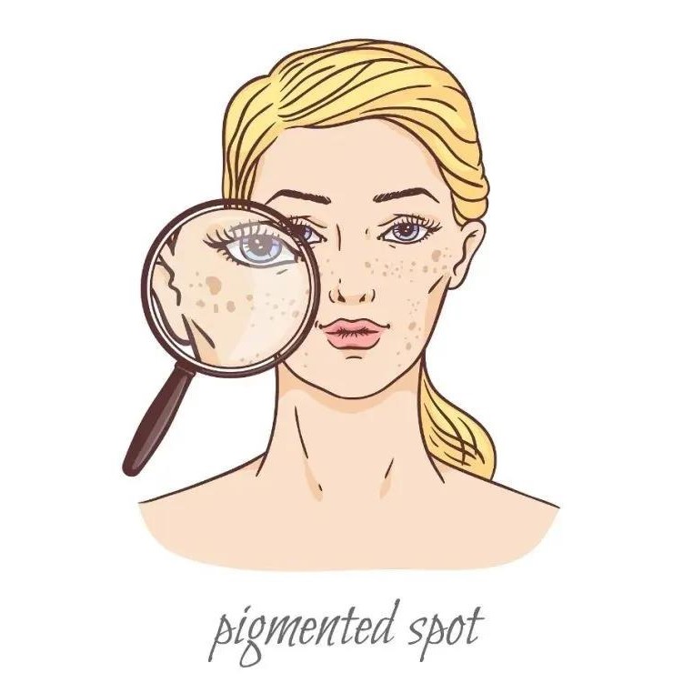 晒斑 晒斑就是常说的黑斑,大多是因为日光照射引起的,通常会出现在